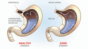 Diagram of healthy stomach on left, GERD stomach on right.